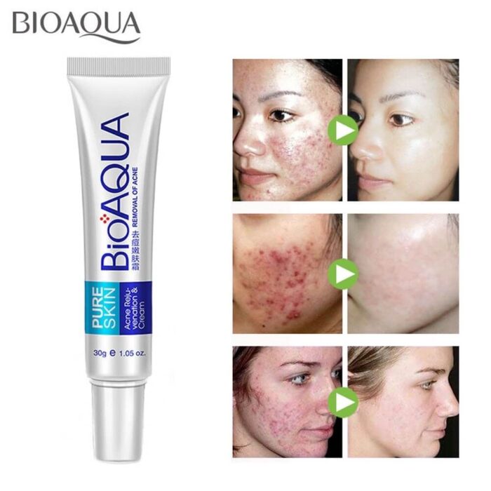 BIOAQUA Pure Skin Acne Removal Cream-3 BIOAQUA Pure Skin Acne Removal Cream