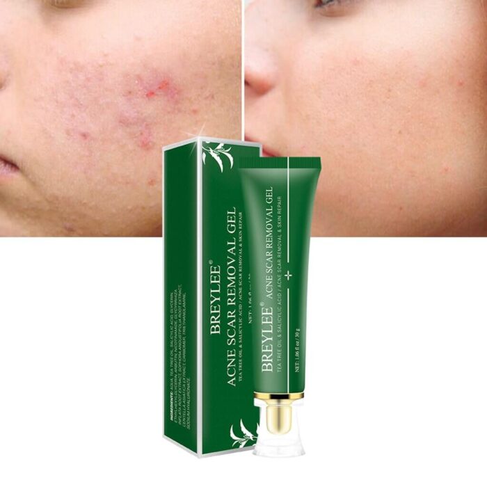 Breylee Acne Scar Removal Gel-3 Breylee Acne Scar Removal Gel-3