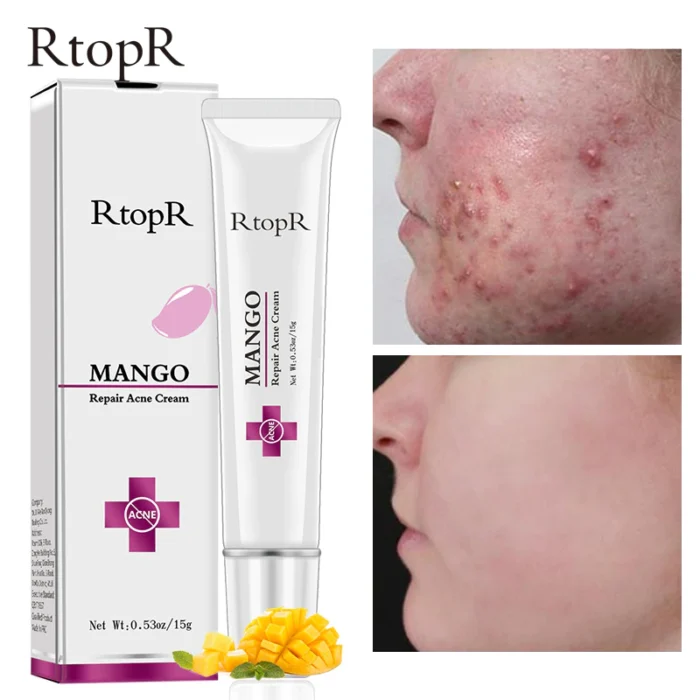 RTOPR Mango Repair Acne Cream-2 RTOPR Mango Repair Acne Cream-2